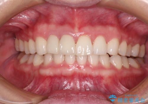 一度諦めた矯正にチャレンジしたい インビザラインとセラミック治療の治療後