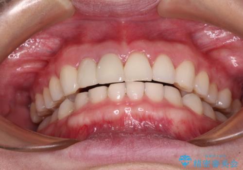 一度諦めた矯正にチャレンジしたい インビザラインとセラミック治療の治療後