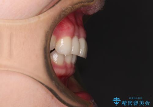 一度諦めた矯正にチャレンジしたい インビザラインとセラミック治療の治療後