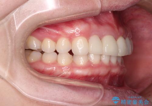 一度諦めた矯正にチャレンジしたい インビザラインとセラミック治療の治療後