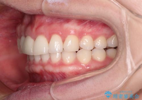 一度諦めた矯正にチャレンジしたい インビザラインとセラミック治療の治療後