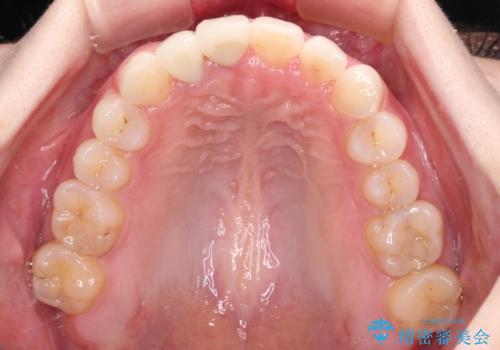 一度諦めた矯正にチャレンジしたい インビザラインとセラミック治療の治療後