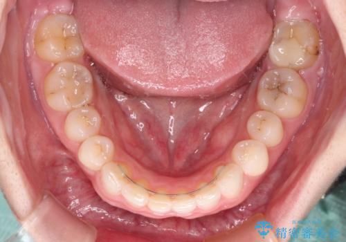 一度諦めた矯正にチャレンジしたい インビザラインとセラミック治療の治療後