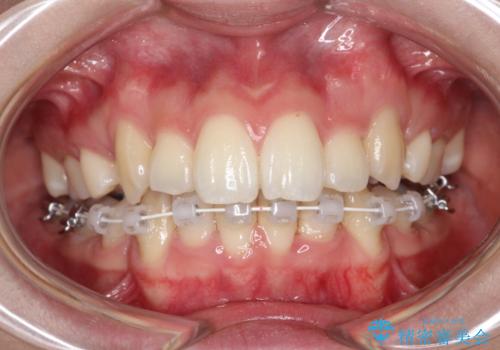 重度のガタガタ ハーフリンガルによる目立たない抜歯矯正の治療中