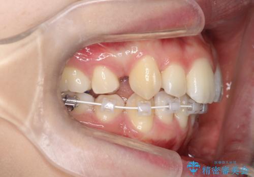 重度のガタガタ　ハーフリンガルによる目立たない抜歯矯正の治療中