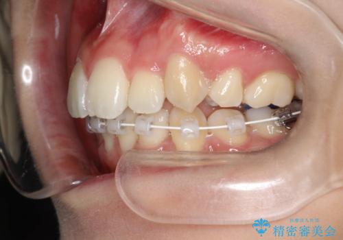 重度のガタガタ　ハーフリンガルによる目立たない抜歯矯正の治療中