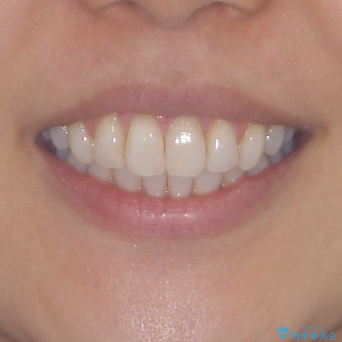 少しだけ飛び出た前歯を整えたい インビザラインによる矯正治療の治療後(顔貌)