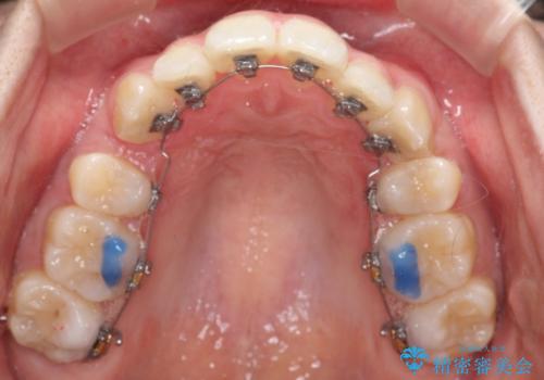 重度のガタガタ ハーフリンガルによる目立たない抜歯矯正の治療中