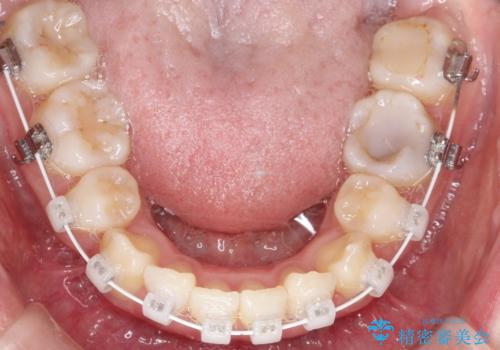 重度のガタガタ ハーフリンガルによる目立たない抜歯矯正の治療中