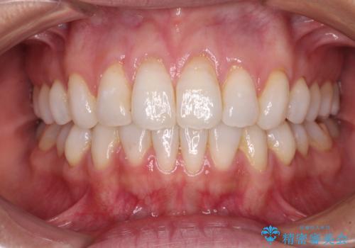 少しだけ飛び出た前歯を整えたい インビザラインによる矯正治療の症例 治療後