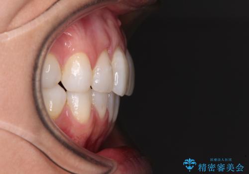 少しだけ飛び出た前歯を整えたい インビザラインによる矯正治療の治療後