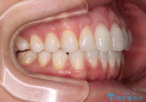 少しだけ飛び出た前歯を整えたい インビザラインによる矯正治療の治療後