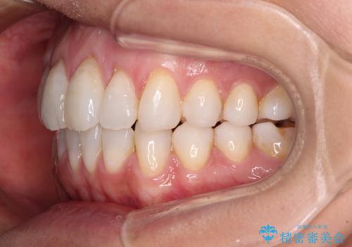 少しだけ飛び出た前歯を整えたい インビザラインによる矯正治療の治療後