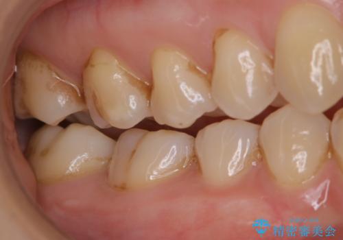 歯磨きをしても奥歯のザラつきが取れないの治療前