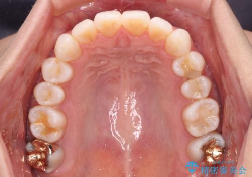 少しだけ飛び出た前歯を整えたい インビザラインによる矯正治療の治療後