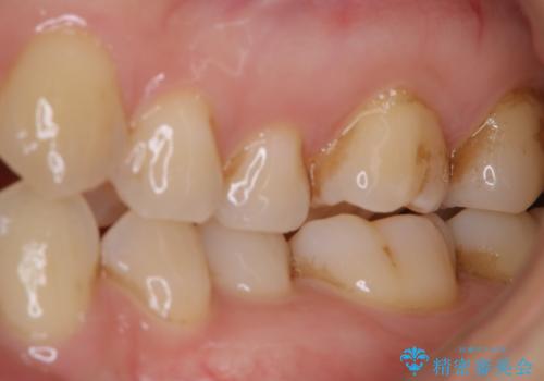 歯磨きをしても奥歯のザラつきが取れないの治療前