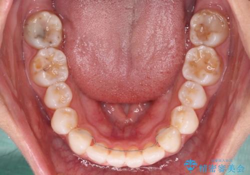 少しだけ飛び出た前歯を整えたい インビザラインによる矯正治療の治療後