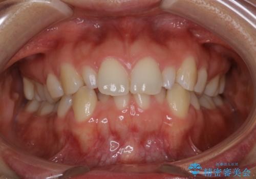 矮小歯を綺麗な歯に。矯正とセラミックの総合治療の治療前