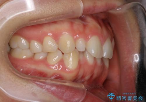 矮小歯を綺麗な歯に。矯正とセラミックの総合治療の治療前