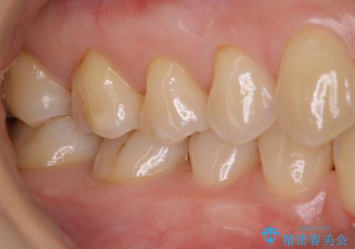 歯磨きをしても奥歯のザラつきが取れないの治療後