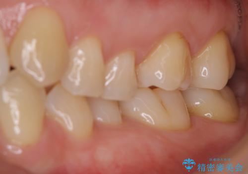歯磨きをしても奥歯のザラつきが取れないの治療後