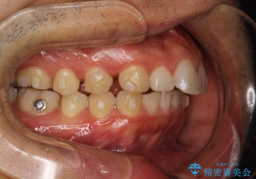 出っ歯が気になる インビザラインによる出っ歯の目立たない矯正の治療中