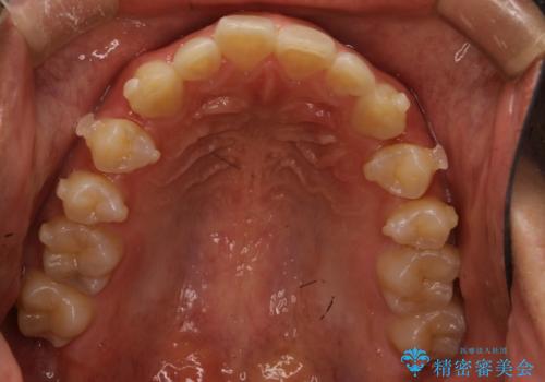 出っ歯が気になる インビザラインによる出っ歯の目立たない矯正の治療中