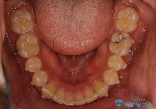 出っ歯が気になる　インビザラインによる出っ歯の目立たない矯正の治療中