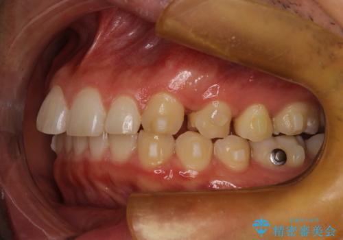 出っ歯が気になる インビザラインによる出っ歯の目立たない矯正の治療中