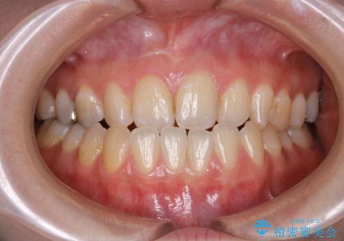 歯がないところに歯をつくる:矯正とセラミックの合わせ技で審美的な口元をの治療前