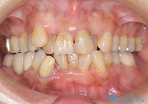 親知らずの移植 4年半経過症例 70代女性の治療中