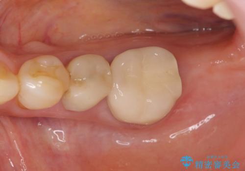 親知らずの移植 4年半経過症例 70代女性の治療中