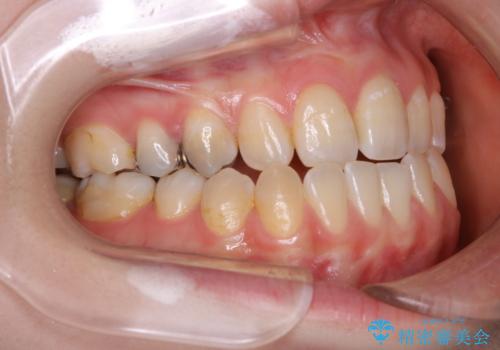 歯がないところに歯をつくる:矯正とセラミックの合わせ技で審美的な口元をの治療前