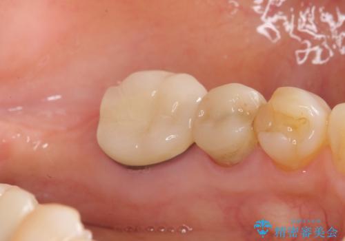 親知らずの移植 4年半経過症例 70代女性の治療中