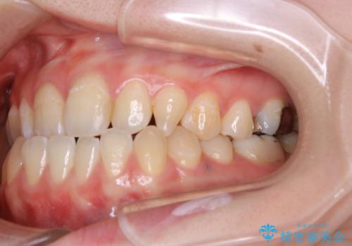 歯がないところに歯をつくる:矯正とセラミックの合わせ技で審美的な口元をの治療前