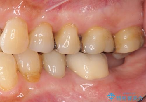 親知らずの移植 4年半経過症例 70代女性の治療中
