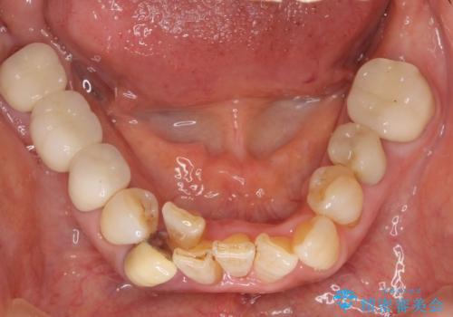 親知らずの移植 4年半経過症例 70代女性の治療中