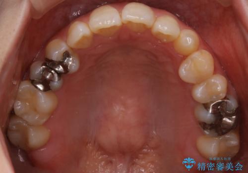 歯がないところに歯をつくる:矯正とセラミックの合わせ技で審美的な口元をの治療前