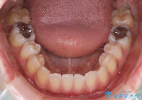 歯がないところに歯をつくる:矯正とセラミックの合わせ技で審美的な口元をの治療前