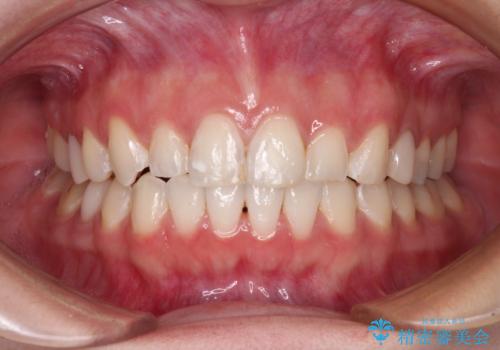 インビザライン単独では困難 補助装置を併用した矯正治療の治療後