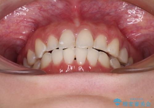 インビザライン単独では困難 補助装置を併用した矯正治療の治療後