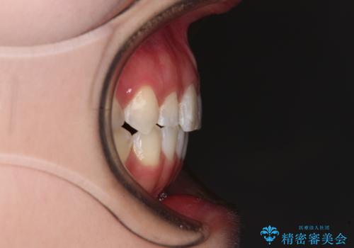 インビザライン単独では困難 補助装置を併用した矯正治療の治療後