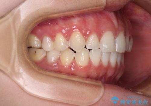 インビザライン単独では困難 補助装置を併用した矯正治療の治療後