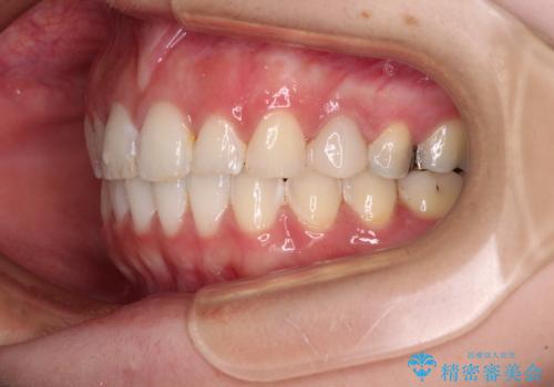 インビザライン単独では困難 補助装置を併用した矯正治療の治療後
