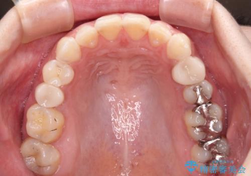 インビザライン単独では困難 補助装置を併用した矯正治療の治療後