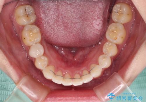 インビザライン単独では困難 補助装置を併用した矯正治療の治療後