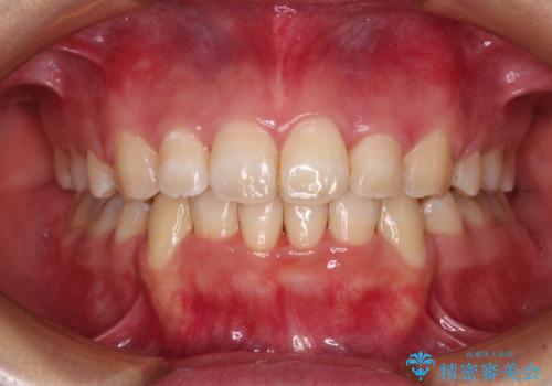 前歯の出っ歯と口の閉じにくさを抜歯矯正で改善　目立たないワイヤー矯正の症例 治療後