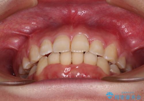 前歯の出っ歯と口の閉じにくさを抜歯矯正で改善 目立たないワイヤー矯正の治療後