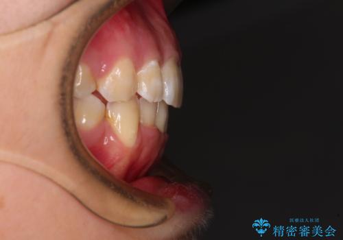 前歯の出っ歯と口の閉じにくさを抜歯矯正で改善 目立たないワイヤー矯正の治療後