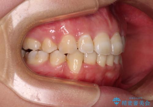 前歯の出っ歯と口の閉じにくさを抜歯矯正で改善 目立たないワイヤー矯正の治療後